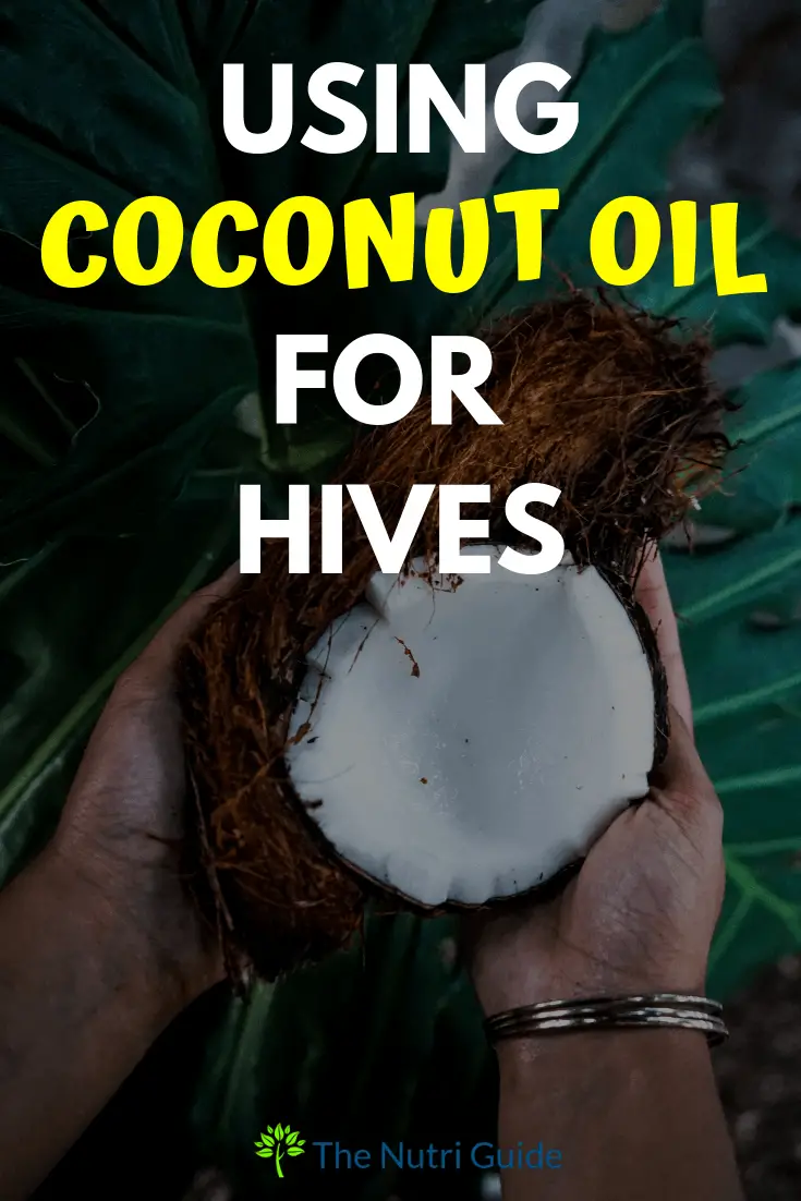 coconut oil for hives