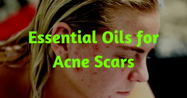 essential oils for acne scars 1