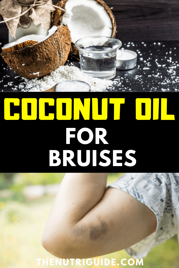 coconut oil for bruises